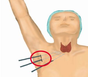 ▲ 내시경 절제술-흉터가 겨드랑이에 생기게 되게 목에는 전혀 흉터가 남지 않는다.
