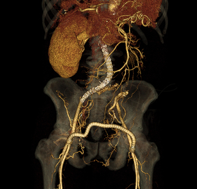 복부대동맥류 스탠트 시술 후 3D CT 사진.